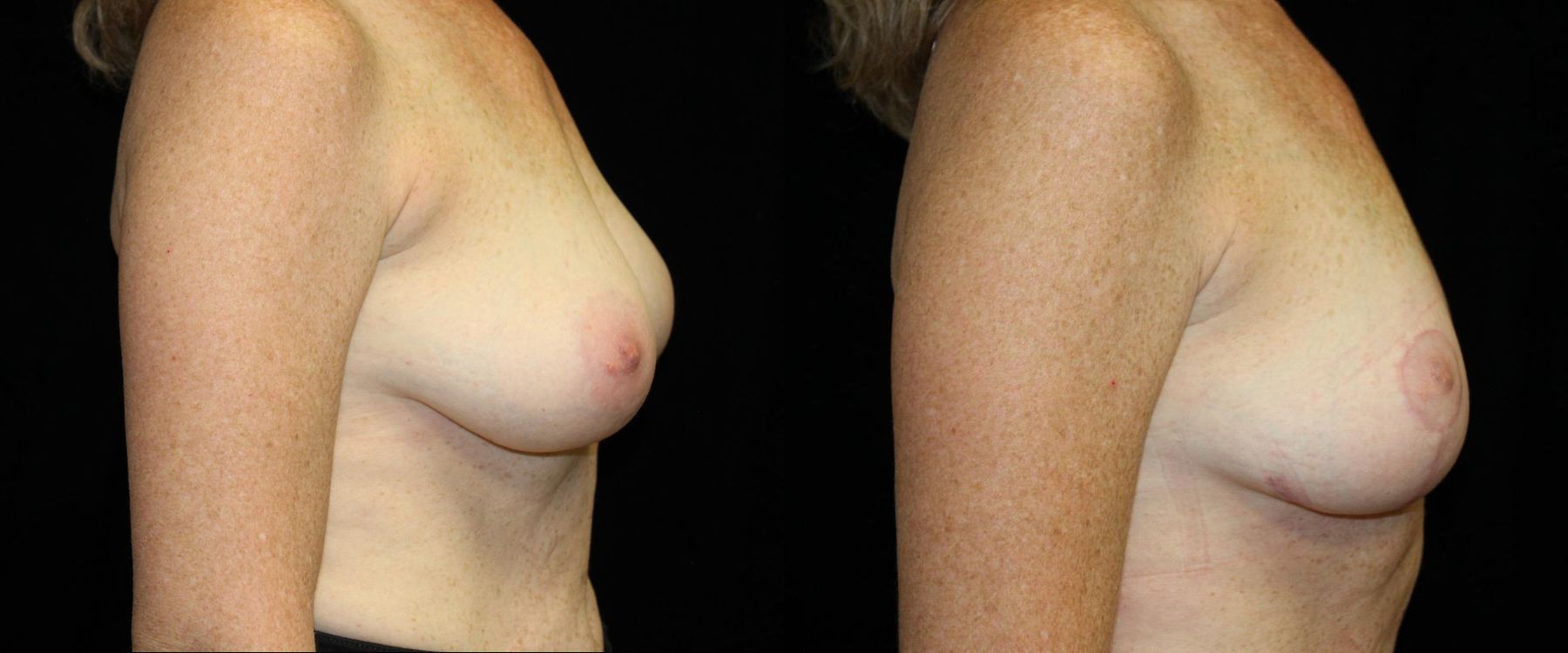 Before and after Breast Lift case 32771 - Angle 3