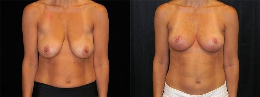 Before and after Breast Lift case 32723