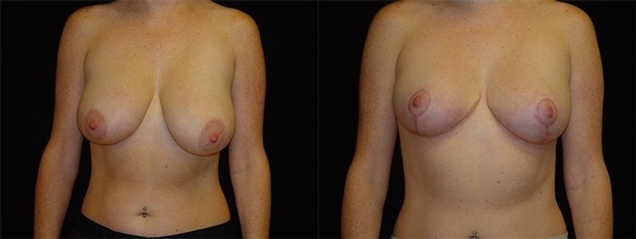 Before and after Breast Lift case 32721