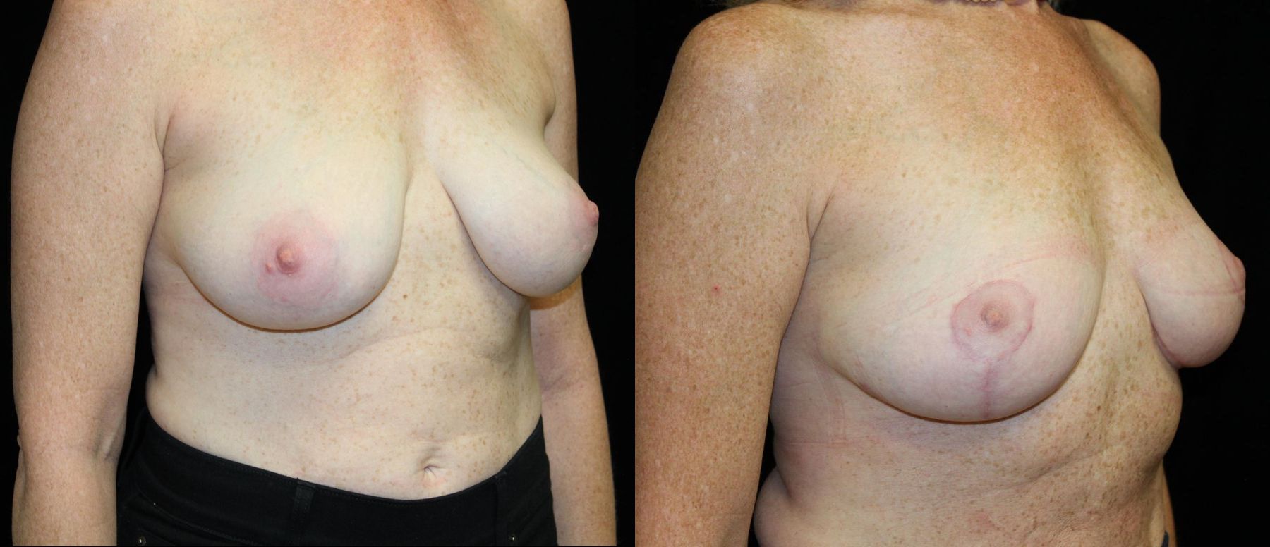Before and after Breast Lift case 32771 - Angle 2