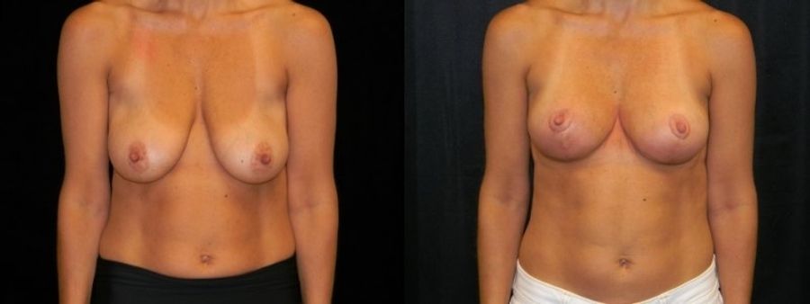 Before and after Breast Lift case 32722