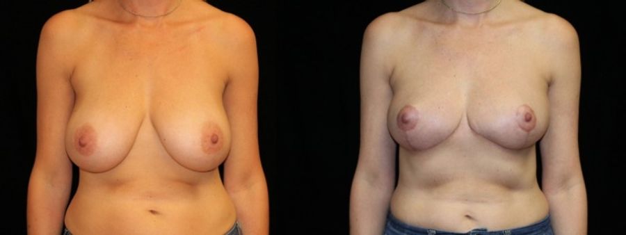 Before and after Breast Lift case 32717