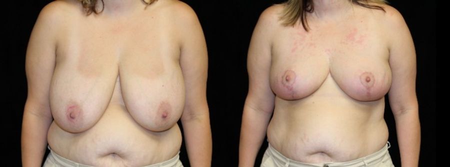 Before and after Breast Lift case 32732
