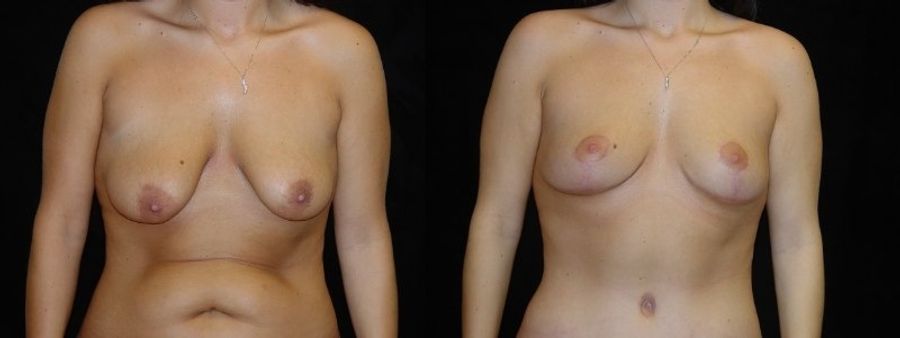 Before and after Breast Lift case 32719