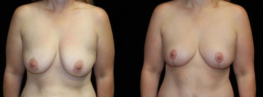 Before and after Breast Lift case 32725