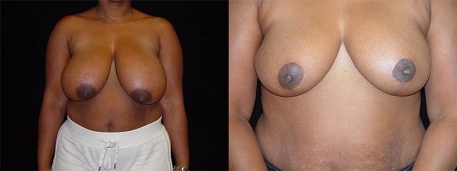 Before and after Breast Reduction case 32608