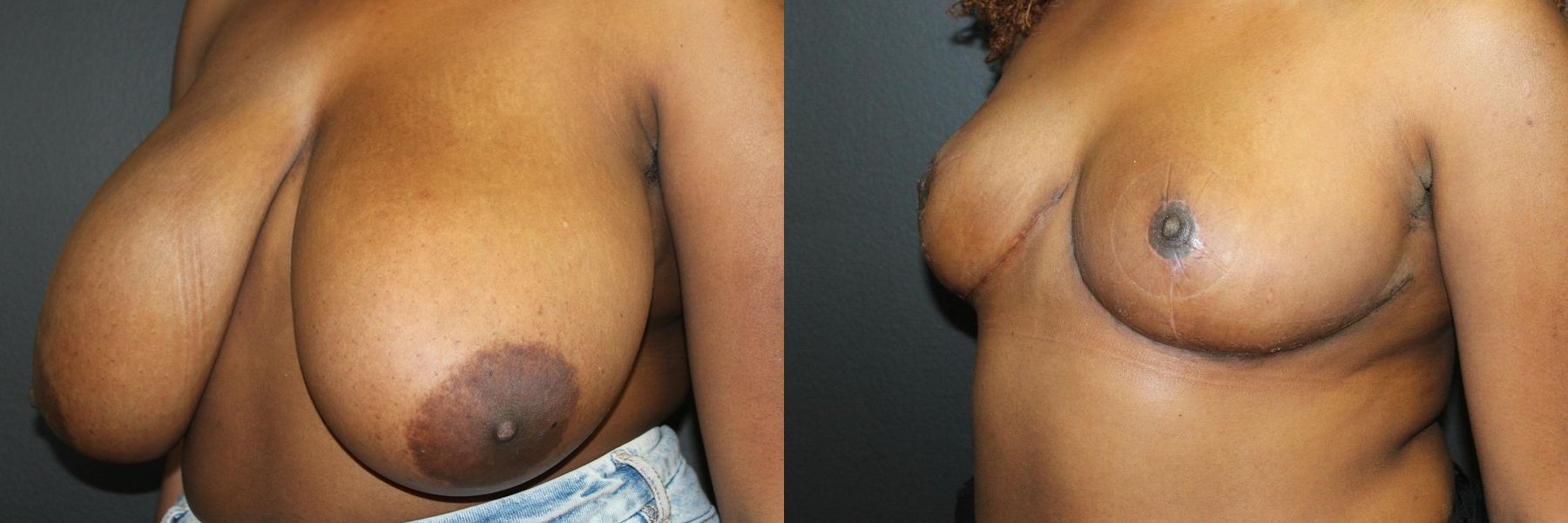 Before and after Breast Reduction case 32591 - Angle 2