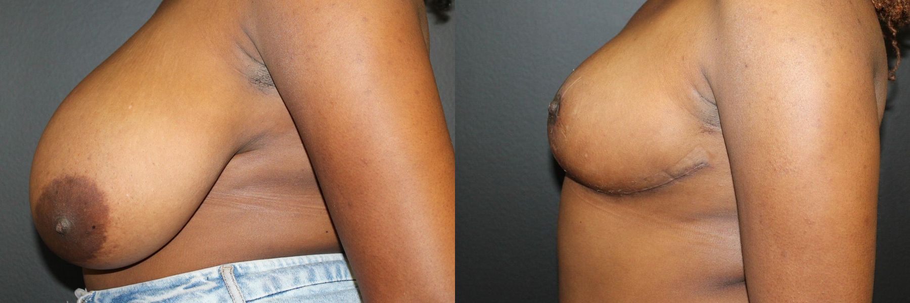 Before and after Breast Reduction case 32591 - Angle 3
