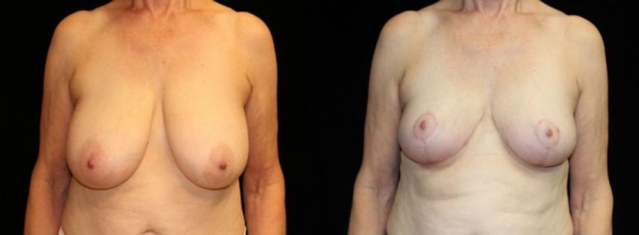 Before and after Breast Reduction case 32619