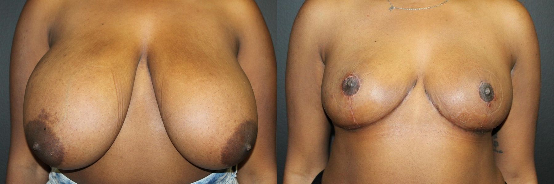 Before and after Breast Reduction case 32591