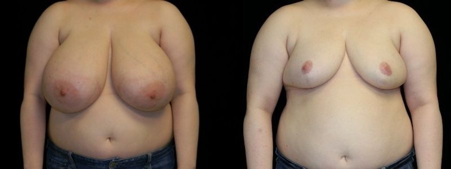 Before and after Breast Reduction case 32600