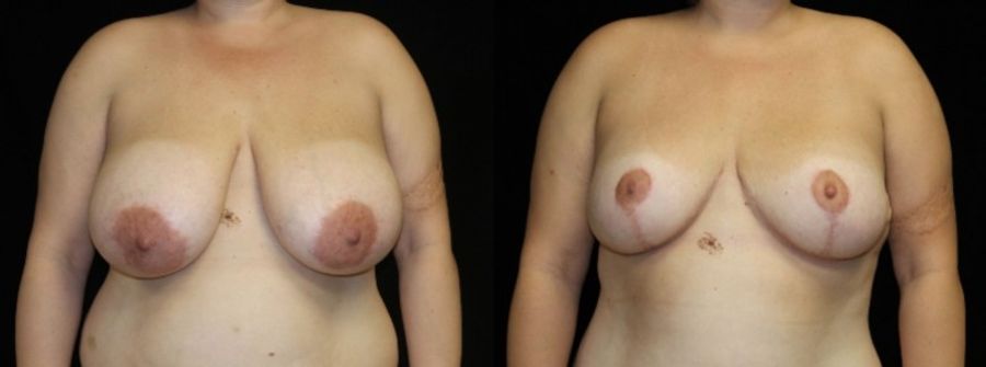 Before and after Breast Reduction case 32623