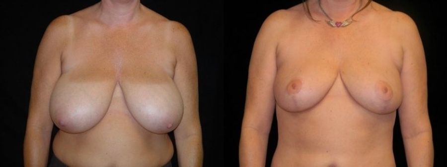 Before and after Breast Reduction case 32618