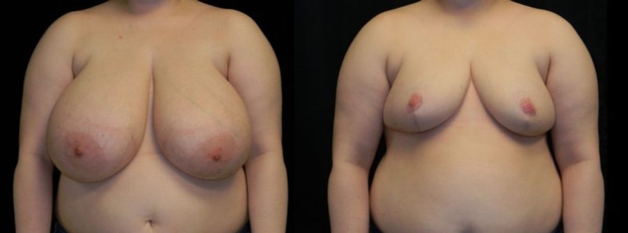 Before and after Breast Reduction case 32637