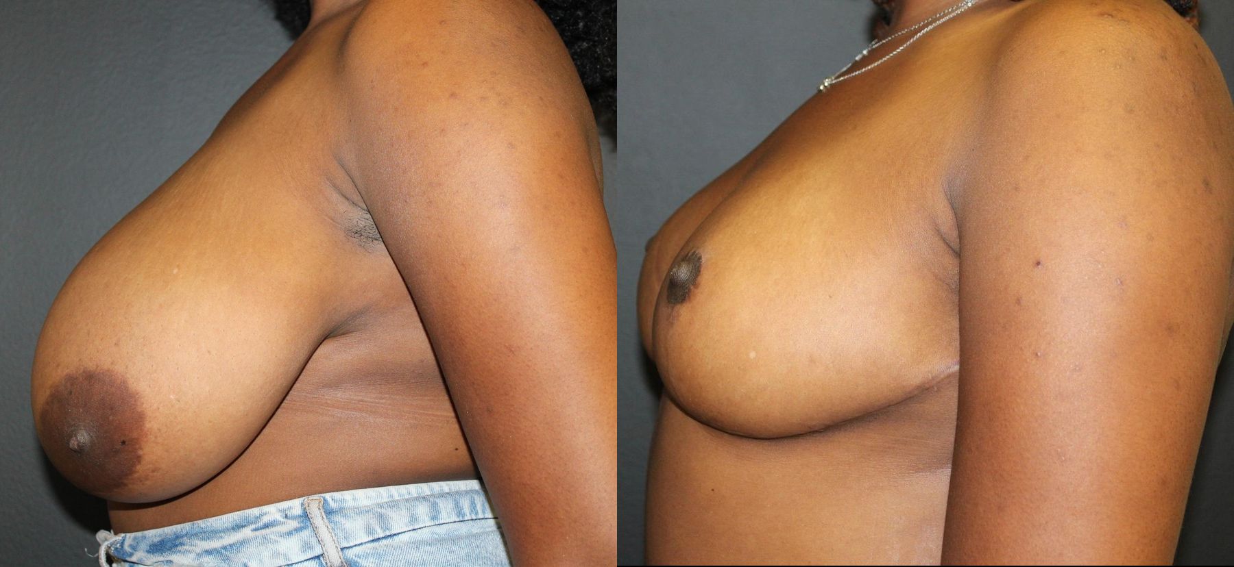 Before and after Breast Reduction case 32768 - Angle 2