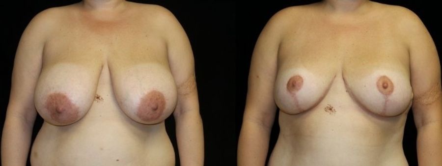 Before and after Breast Reduction case 32577