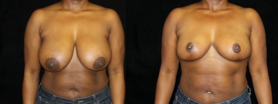 Before and after Breast Reduction case 32580