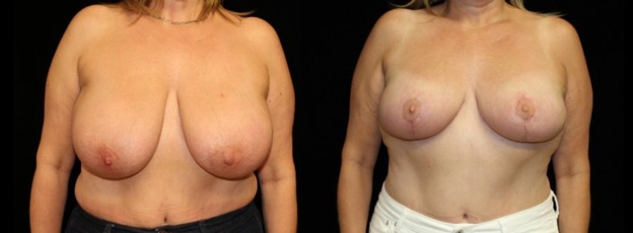 Before and after Breast Reduction case 32640