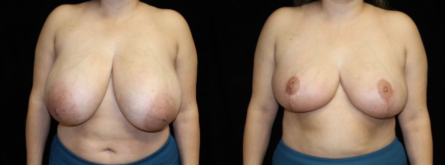 Before and after Breast Reduction case 32657