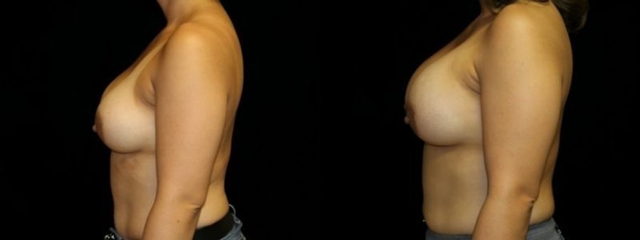 Before and after Breast Revision case 32728 - Angle 3