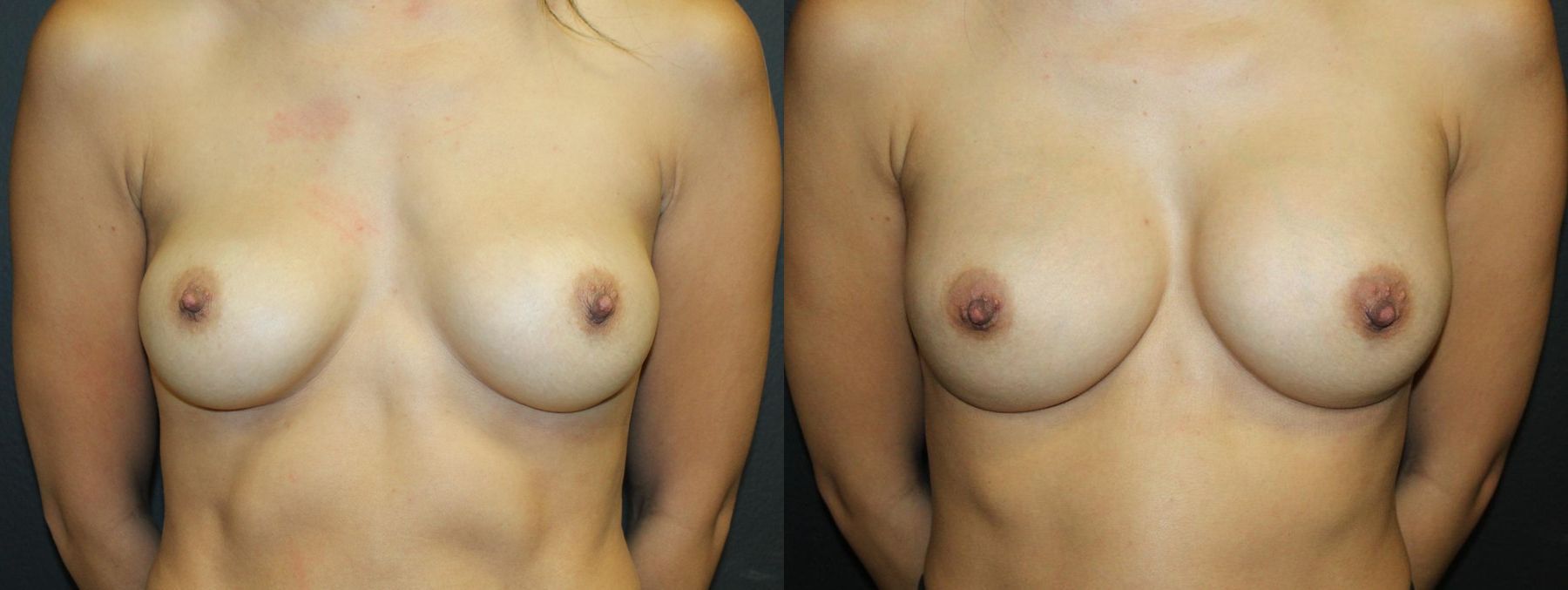 Before and after Breast Revision case 32770
