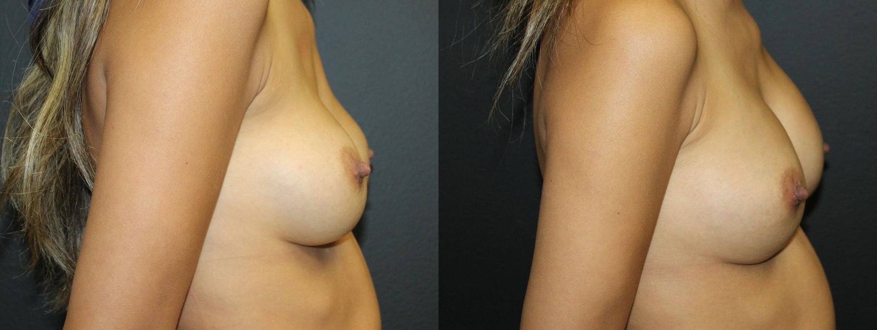 Before and after Breast Revision case 32770 - Angle 3