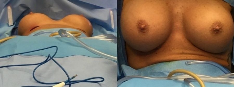Before and after Breast Revision case 32718