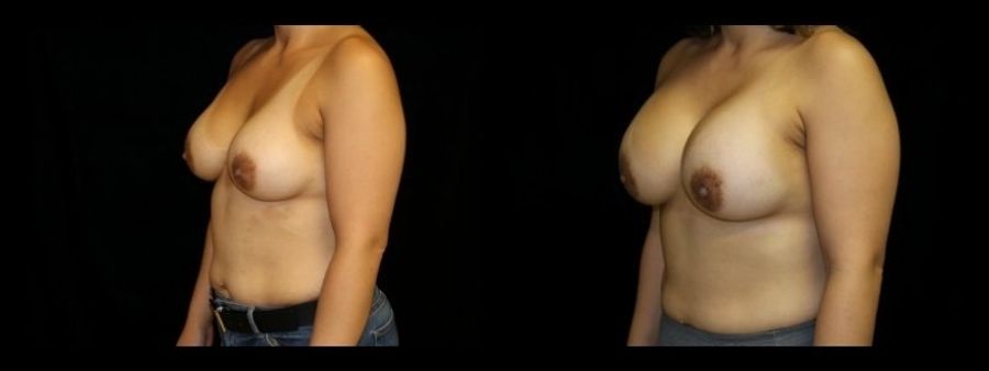 Before and after Breast Revision case 32728 - Angle 2