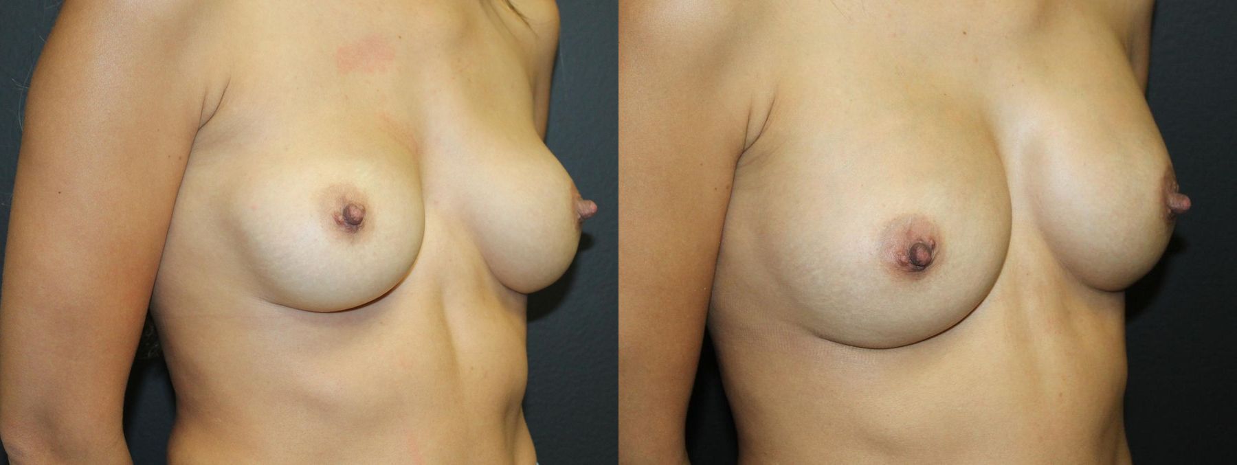 Before and after Breast Revision case 32770 - Angle 2