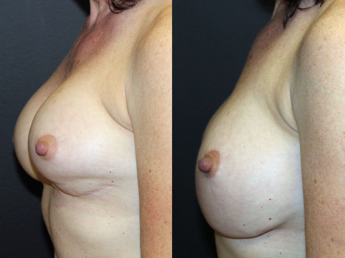 Before and after Breast Revision case 32713 - Angle 2