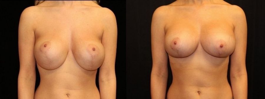 Before and after Breast Revision case 32751