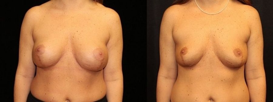 Before and after Breast Revision case 32727