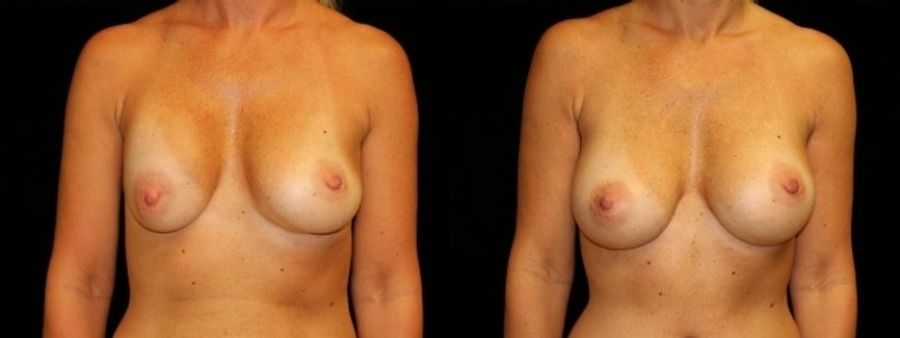 Before and after Breast Revision case 32726