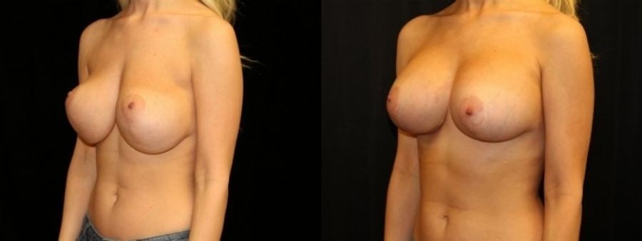 Before and after Breast Revision case 32724 - Angle 2