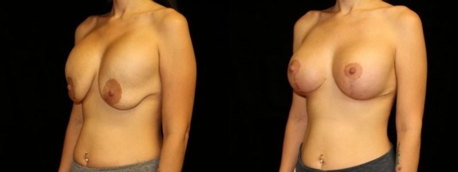 Before and after Breast Revision case 32731 - Angle 2