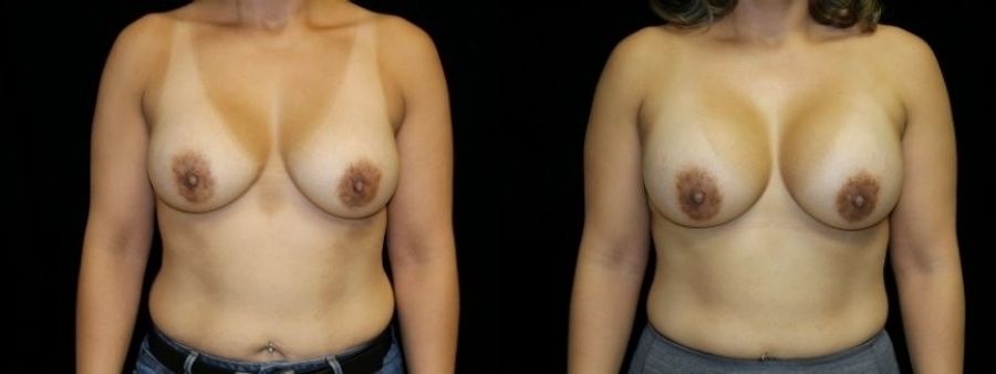 Before and after Breast Revision case 32728