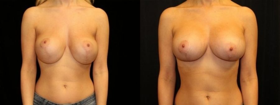 Before and after Breast Revision case 32724