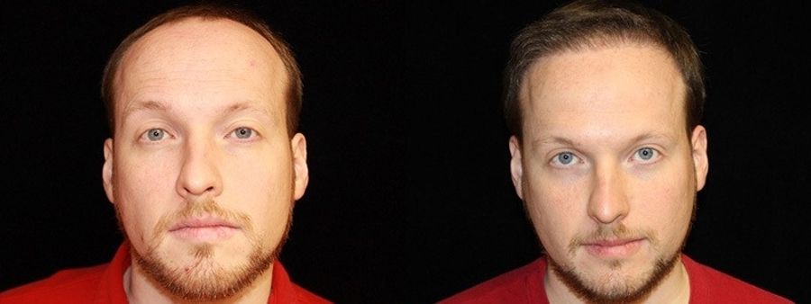Before and after Hair Transplantation case 32759