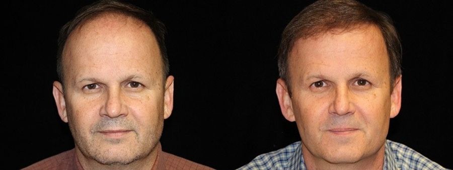 Before and after Hair Transplantation case 32763