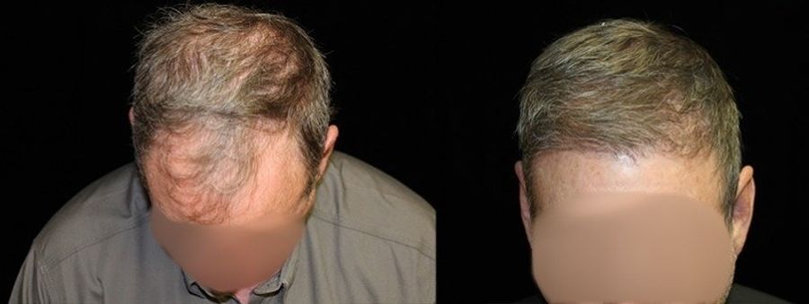 Before and after Hair Transplantation case 32765