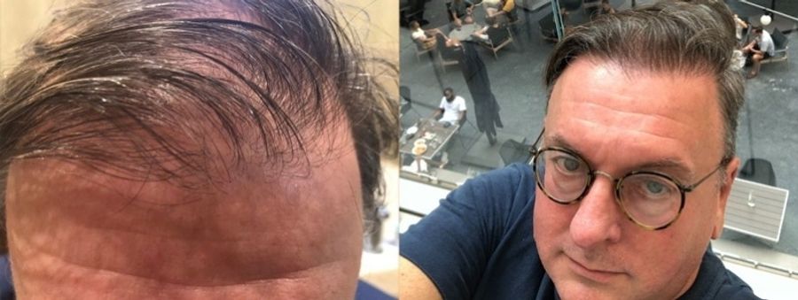 Before and after Hair Transplantation case 32757
