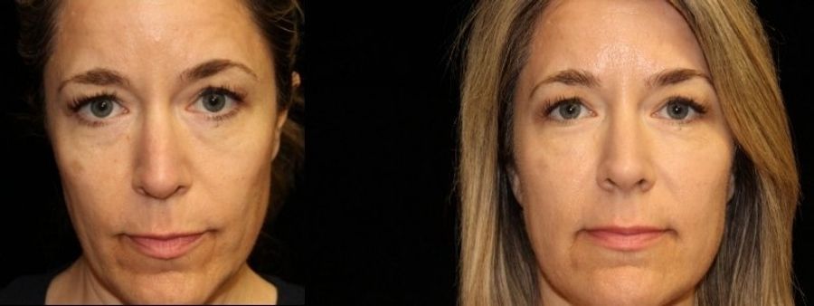 Before and after Injectables - Face case 32766