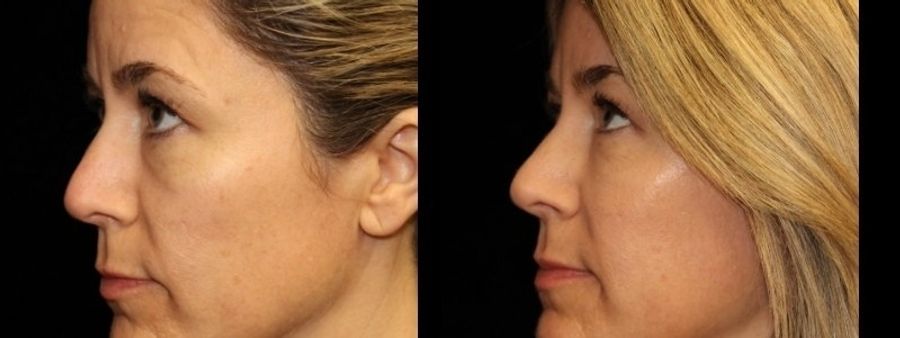 Before and after Injectables - Face case 32766 - Angle 3