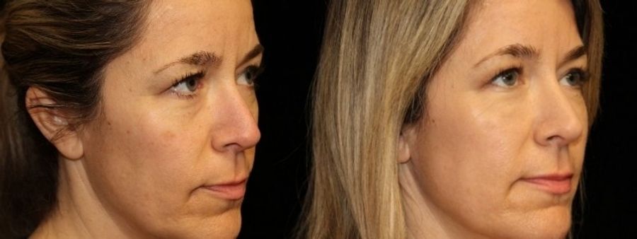 Before and after Injectables - Face case 32766 - Angle 2