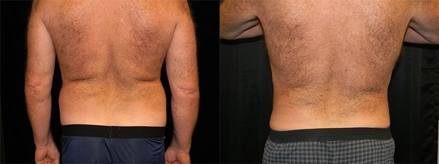 Before and after Liposuction case 32752