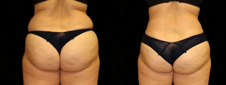 Before and after Liposuction case 32743