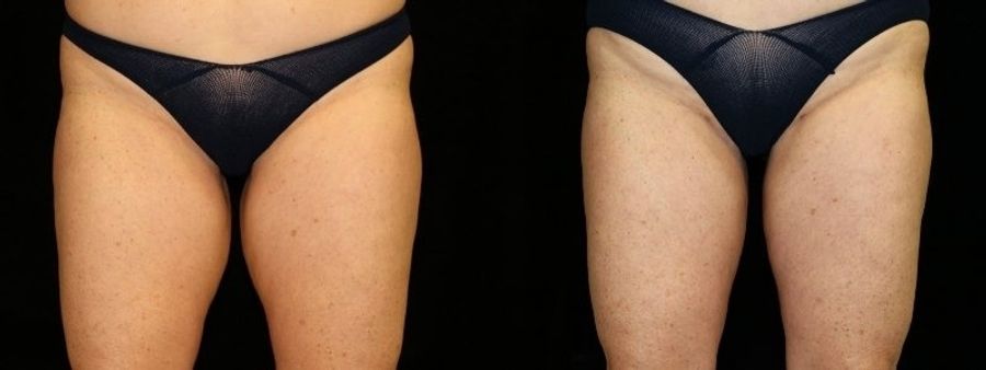 Before and after Liposuction case 32747