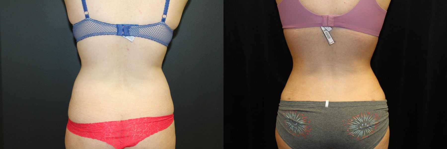 Before and after Liposuction case 32769