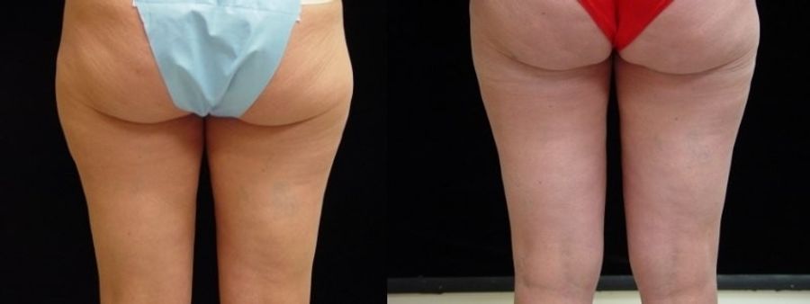 Before and after Liposuction case 32738