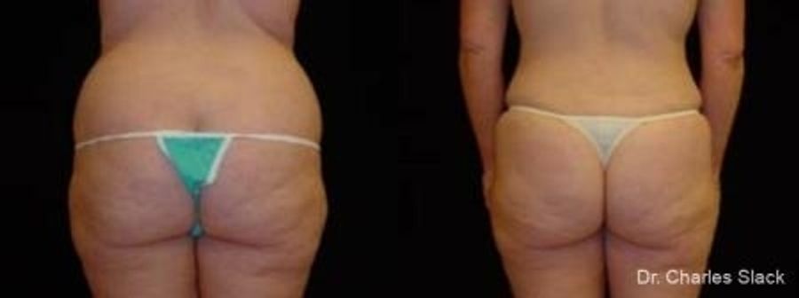 Before and after Liposuction case 32696